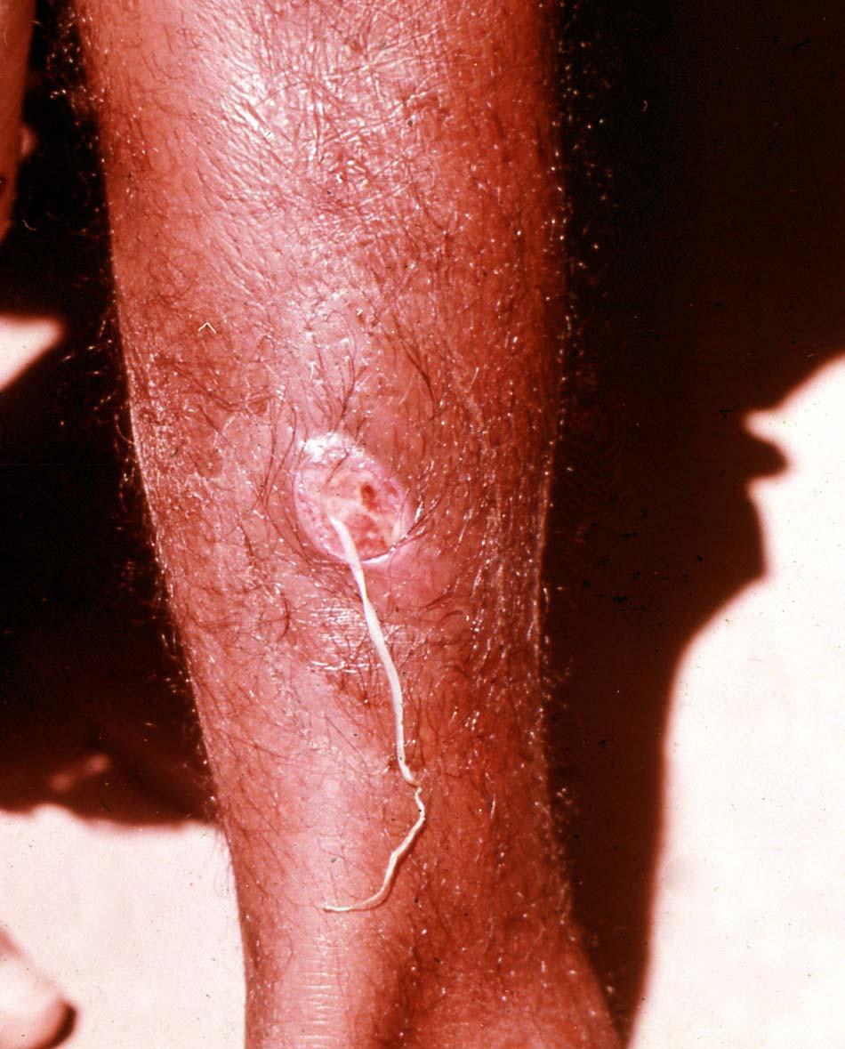 Dracunculus Lesion On Leg