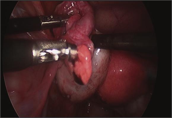 2 Minimally Invasive Surgery assessment of tubal architecture can be made with diagnostic laparoscopy, which can detect the presence of pelvic adhesions or endometriosis.