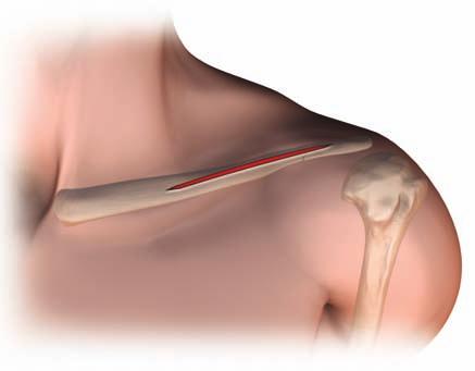 Incision A parallel incision is made along the inferior border of the
