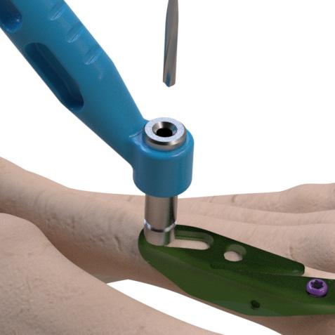 Using the MSP Proximal Drill Guide, drill a hole into the bone in the proximal end of the dog-leg slot.