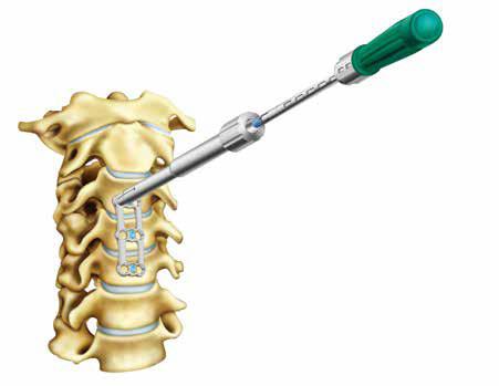 inserting screws. Insert the Awl into the desired bone-screw hole and engage the Awl tip to penetrate into the vertebral body.