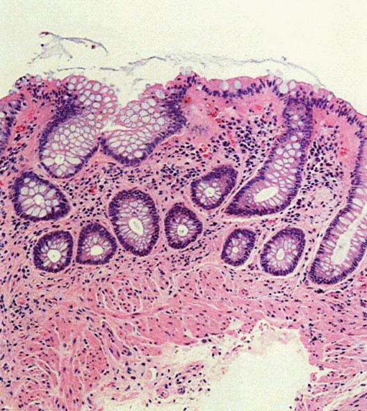 Taooka et al. 618 case was highly associated with lansoprazole, not other kinds of PPI. CONCLUSION A rare case of collagenous colitis was reported.