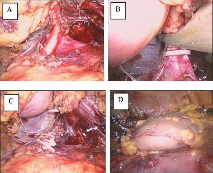 The dissection of the ureter is completed distally up to the bladder wall (Figure 3B and C).