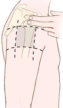 asynchronous with chest compressions delivered over 1 sec Administering Injections Finding sites on the pediatric patient: Deltoid 2-3 fingers below