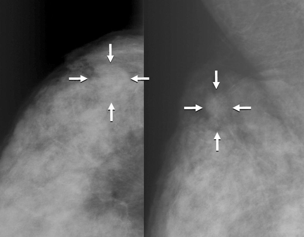 Imaging Findings of Pure and Mixed Tubular Breast Carinomas summarized in Table 1. All 28 patients with tubular carcinoma presented with a mass on sonography.
