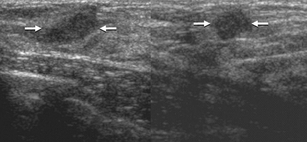 These patients underwent sonography because of a clinically palpable lump (n = 6), nipple discharge (n = 1), or for screening purposes (n = 2).