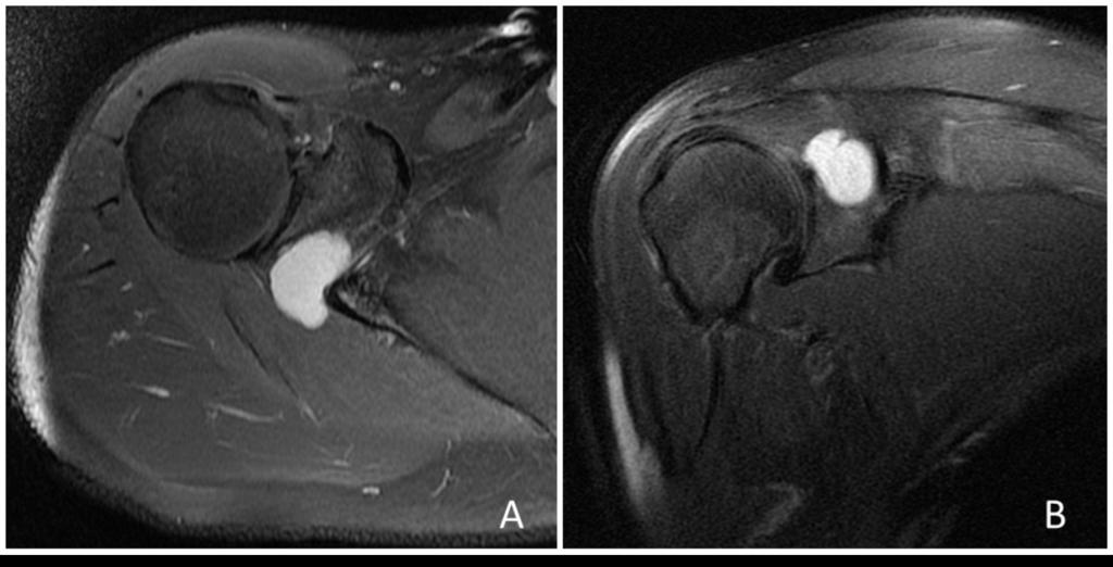10: Axial and coronal fat saturated T2WI of the right shoulder demonstrate a paralabral cyst at the level of