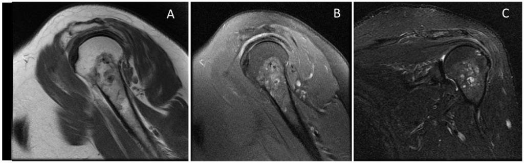 Fig. 3: Sagittal Proton density (A) fat saturated T2WI (B) and coronal STIR (C) MR images of the left shoulder demonstrate bone marrow signal intensity alteration in the metaphyseal