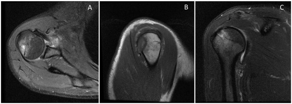 Fig. 7: Axial - sagittal proton density (A and B) and Coronal fat saturated T2WI (C) MR images of the