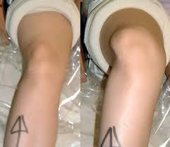Instability Observe High energy activity High Q-angle Patella loses contact with trochlea Capsule