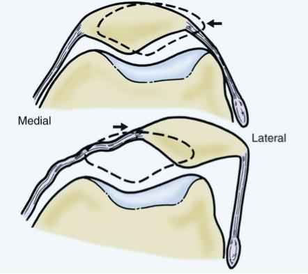 lateral displacement of the patella in full extension and at 30 Divide patella into 4 quadrants