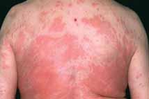 Case Study #2 79 year old woman allergic to shellfish Taken out to dinner no known exposure She developed hives over her face, chest, and back Took Benadryl orally Called EMS