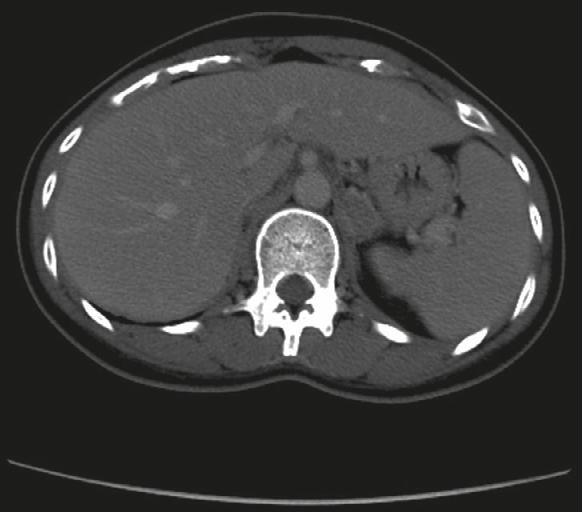 Case report A 28-year-old-woman was admitted with severe weakness and soreness in bilateral lower limbs.