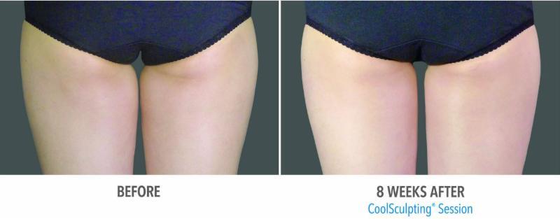 CoolSculpting is designed to eliminate stubborn fat deposits that resist traditional weight-loss methods.