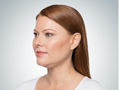 KYBELLA is an injectable solution that safely targets and destroys fat cells under the chin.