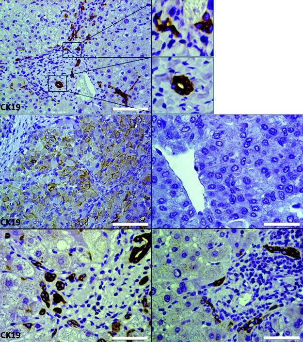 Cytokeratin19 positive hepatocellular carcinoma is associated with increased peritumoral ductular reaction., 2016; 15 (3): 386-393389 A 100 μm B 50 μm 50 μm C 50 μm 50 μm Figure 1.