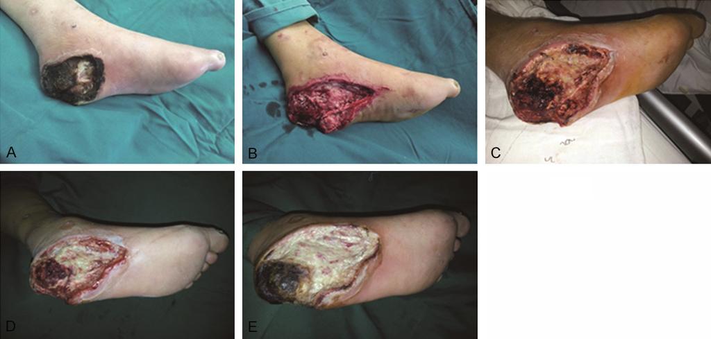 Figure 2. Observation of diabetic foot in the control group treated with vaseline and gauze. A. A severe ischemic diabetic foot ulcer in the heel of the left foot.