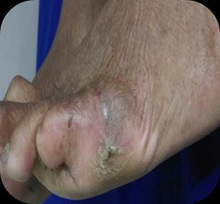 These changes make diabetic foot more prone to trauma, ulceration and infection.