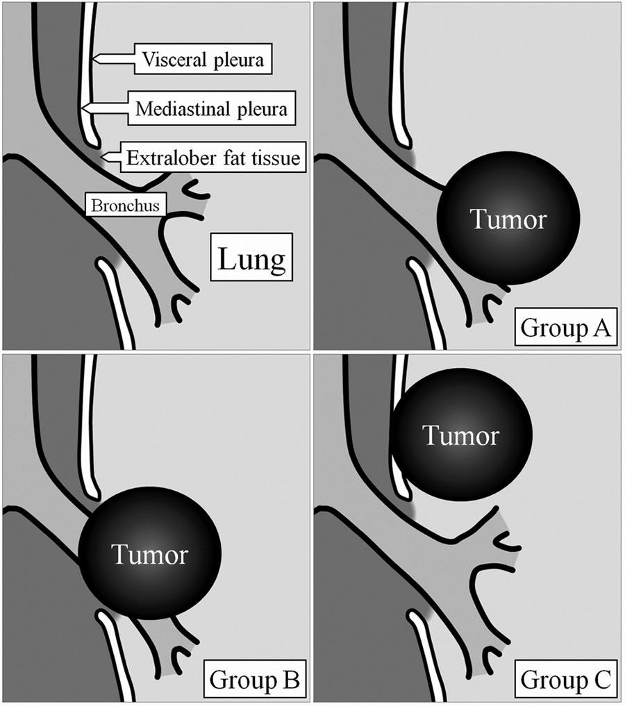 Otsuka et al. Journal of Thoracic Oncology Volume 5, Number 10, October 2010 there is no pleural cover on the soft tissue around the boundary lesion.