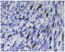 Fig. 4a:H&E 40X-fibrosarcoma (GII): spindle shaped cells arranged in