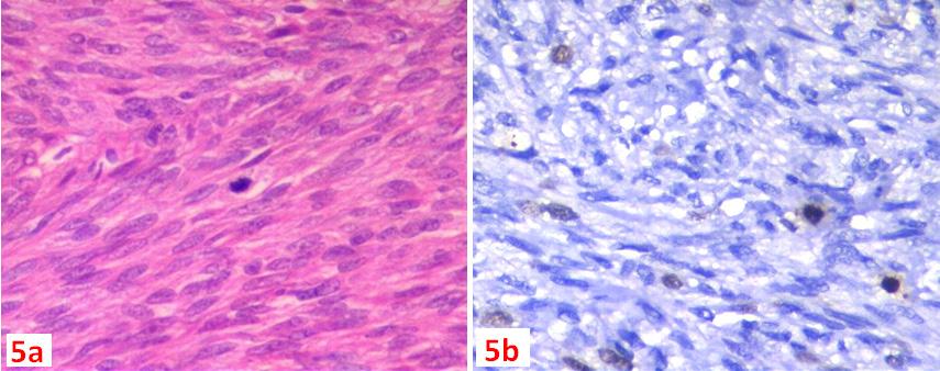 Sridevi. et al. A-583 Fig. 5a: H&E 40X- DFSP(GI) shows spindle shaped cells. Fig5b: 40X Ki67immunostainhighlights mitosis.