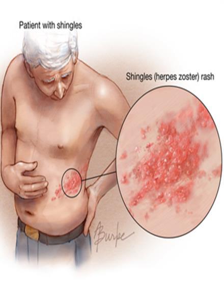 Type 3, also known as Varicella zoster virus infects only humans and causes chickenpox. A person who had chickenpox as a child may harbor the virus throughout his life.