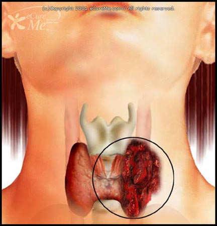 , Serum thyroglobulin is a poor diagnostic biomarker of malignancy in follicular and Hurthle-cell neoplasms of the