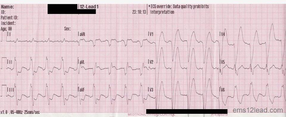 3 28 22 Another pt with LBBB