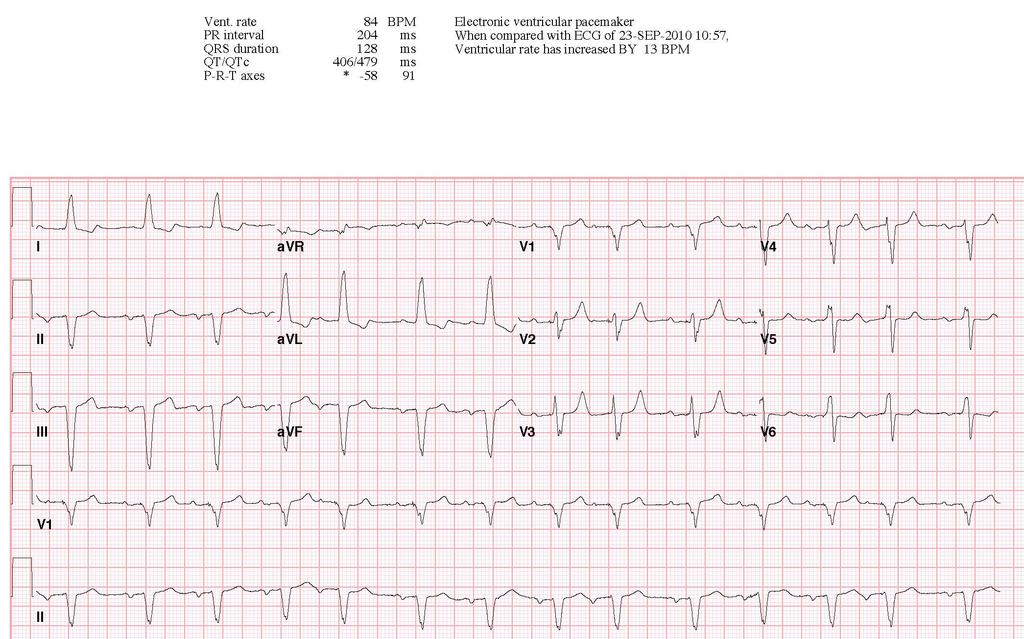 of AMI in LBBB 1.