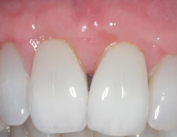 Describe how to use acellular dermis to treat recession gaining root coverage, keratinized gingiva and generate reattachment.