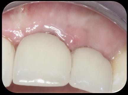 TREATING PERI-IMPLANTITIS THINKING OUTSIDE IMPLANT REPLACEMENT COURSE OBJECTIVES Recognize the prevalence of peri-mucositis and peri-implantitis infections.