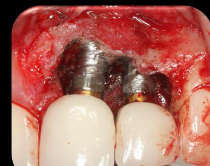 Understand the evidence-based literature showing why peri-implantitis is a non-linear infection phenomenon resulting in an exponentially rapid bone destruction.