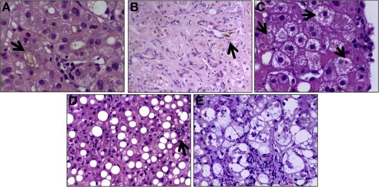 Histologic features independently associated with 90-day survival included in the Histologic AHHS.