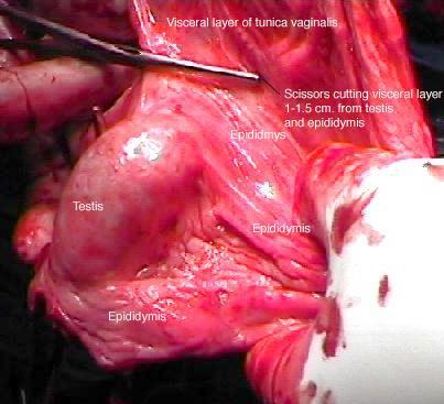 Hydrocele Surgery