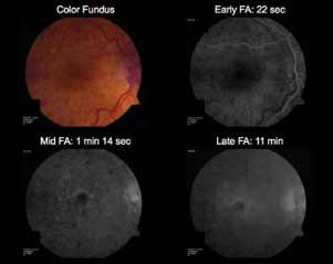 Case Study from CRUISE Figure 1 shows the color fundus and fluorescein angiographic images of a patient from the CRUISE study.