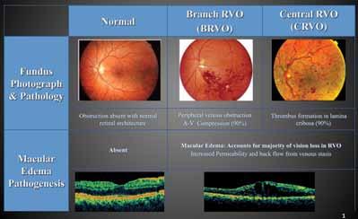 The Early Evolution of Data on Treatments for RVO By Gaurav Shah, MD Retinal vein occlusions (RVOs) affect approximately 160 000 people in the United States per year.
