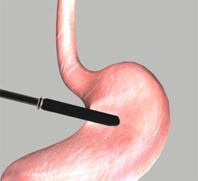 Unit 3: Biliopancreatic Diversion Surgery Surgical Procedure In BPD surgery, the lower two-thirds portion of the stomach is removed.