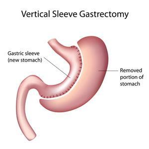 Sleeve Gastrectomy This procedure involves surgery on the stomach only. It removes about two-thirds of the stomach.