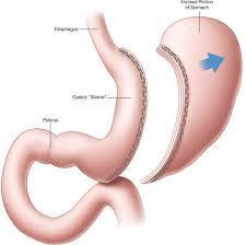 What is the Laparoscopic Sleeve Gastrectomy? The laparoscopic sleeve gastrectomy is a type of bariatric surgery in which a portion of the stomach is surgically removed.