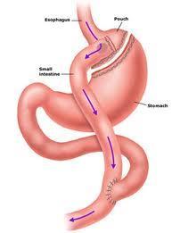 Gastric Bypass A small pouch is created using a surgical stapler The small bowel is divided, using a surgical stapler One end of the small intestine is raised and attached to the stomach pouch The