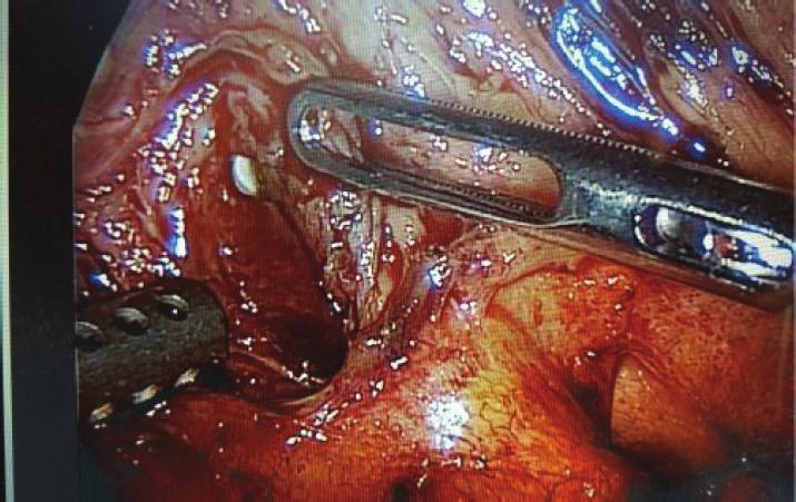 (c) intracorporeal closure of remnant cystic duct stump with absorbable suture. Figure 6: Post-op ERCP demonstrating resolution of Mirizzi syndrome and no cystic duct stump leak.