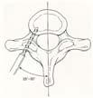 pedicle screw when linked to T1 Cervical spinous process wiring does not improve stiffness