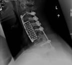 Indications Stand-alone laminectomy Multilevel corpectomy Kyphosis Stand alone if flexible Part