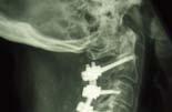 (fit instrumentation to spine) Contoured rods Useful in complex