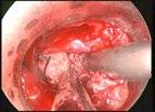 cervical canal stenosis Arnold Chiari