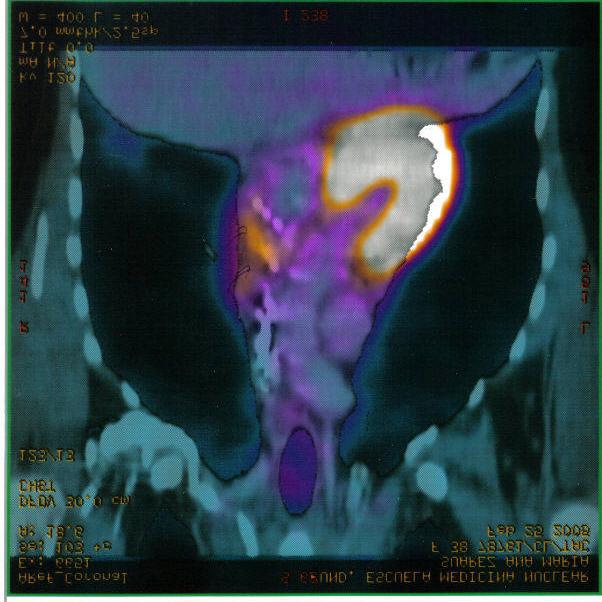 laboratory (proteinogram, LDH, β2 microglobuline), Cervical-Thoraco-Abdominal and Pelvic CT Scan and bone marrow biopsy. The node biopsy was confirmed as Hodgkin s disease.