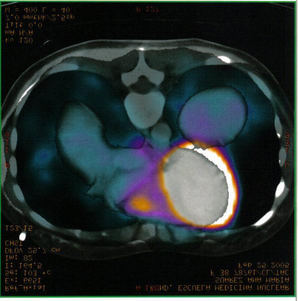 Fig. 4 Patient 2: PET at the year s control post-treatment DISCUSSION The appearance of a residual mass after initial treatment of HD can create problems for therapy management because the mass may