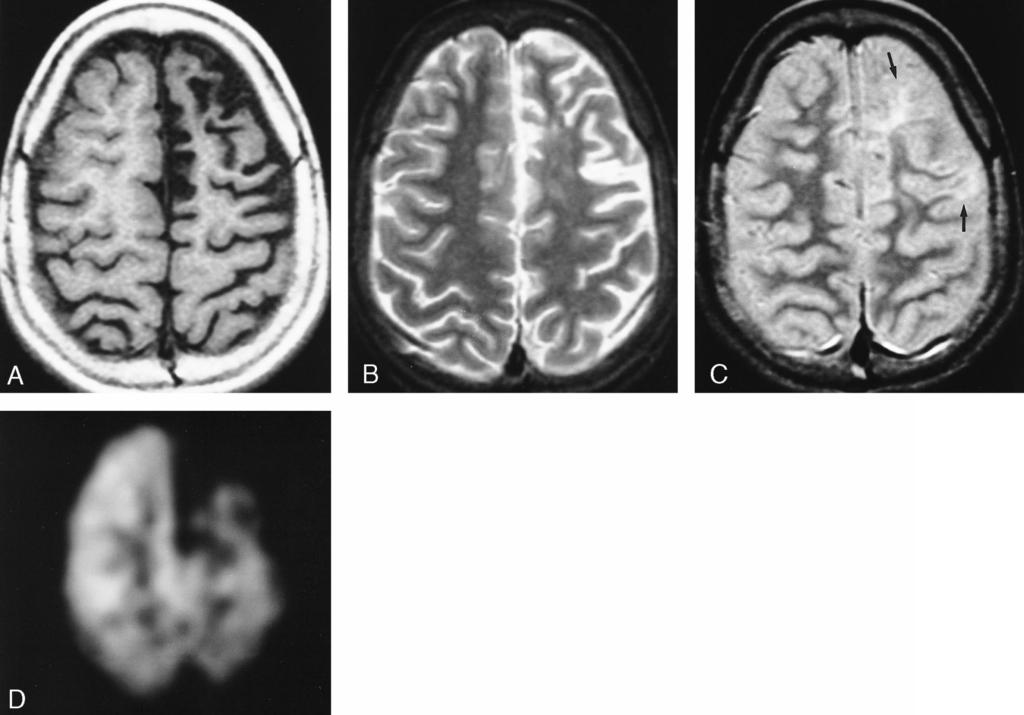 AJNR: 22, August 2001 RASMUSSEN ENCEPHALITIS 1295 FIG 2. Patient 7, a 10-year-old girl with a 5-year history of intractable seizures and progressive cognitive impairment.