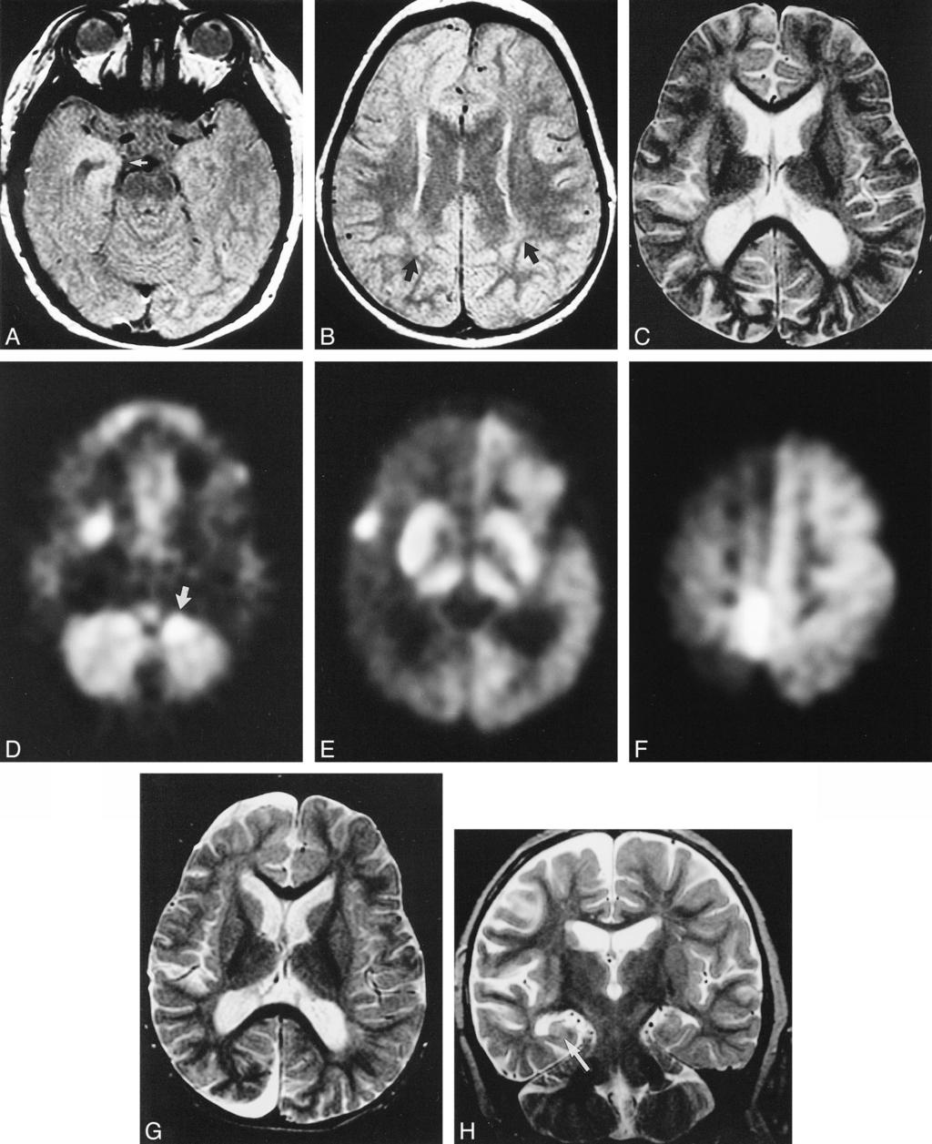 1296 FIORELLA AJNR: 22, August 2001 FIG 3. Patient 3, a 27-month-old boy who presented with a 1-year history of intractable seizures followed by a progressive left hemiparesis.