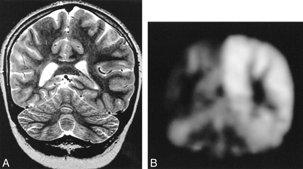 AJNR: 22, August 2001 RASMUSSEN ENCEPHALITIS 1297 FIG 4. Patient 6, a 9-year-old girl who presented with intractable seizures at age 3.